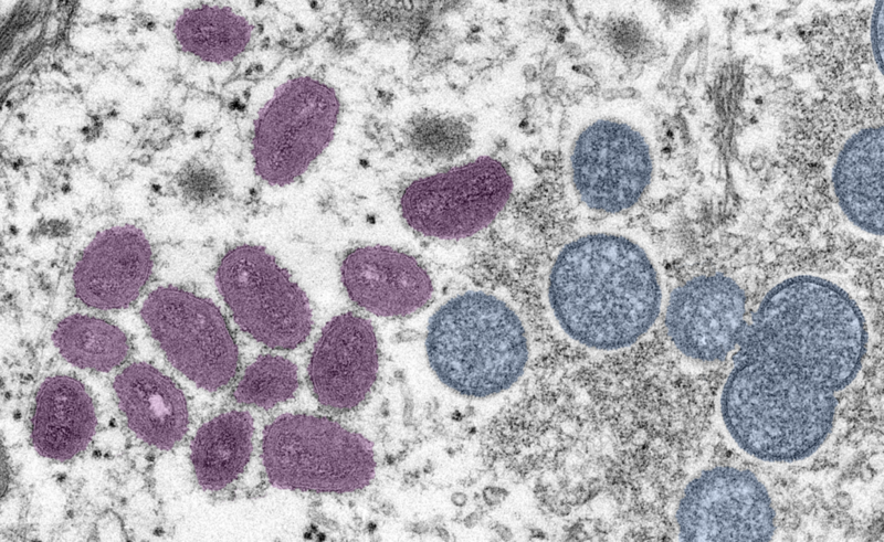Monkeypox cases continue to climb in FL; CDC launches testing through vendor Monkeypox cases continue to climb in FL; CDC launches testing through vendor